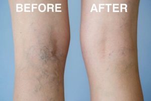 Microsclerotherapy treatment before and after picture