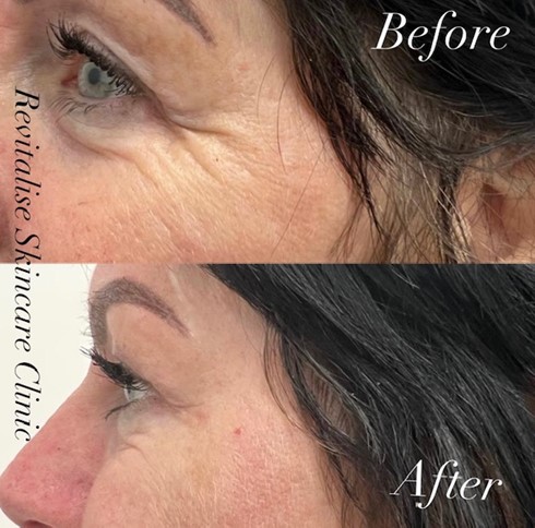before after image of Wrinkle Reduction of a lady